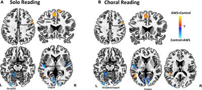 Neural activity during solo and choral reading: A functional magnetic resonance imaging study of overt continuous speech production in adults who stutter